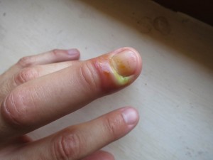 My infected Green Finger in Amritapuri My infected Green Finger in Amritapuri